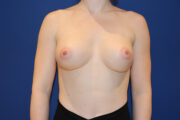 Breast Augmentation