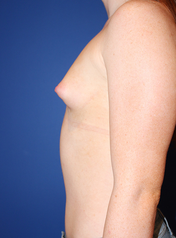 Breast Augmentation Case 37961 Before Photo Breast Augmentation