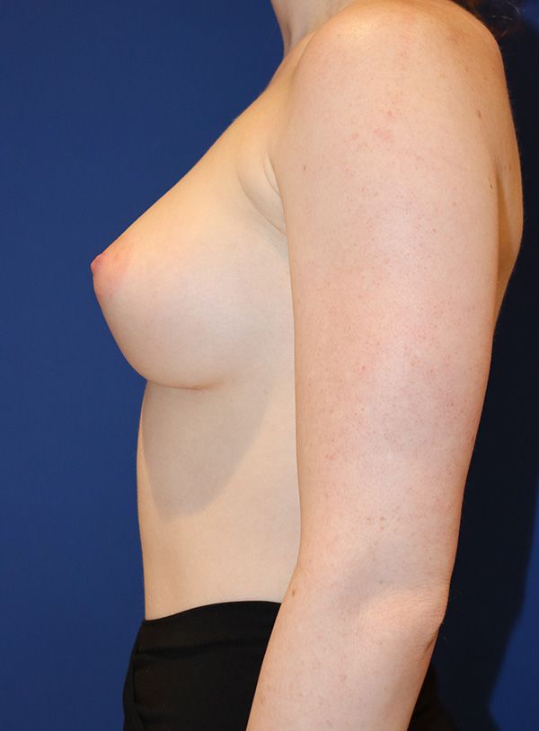 Breast Augmentation Case 37961 After Photo Breast Augmentation