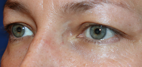 Eyelid Surgery Case 38067 Before Photo Eyelid Surgery