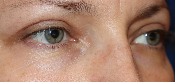Eyelid Surgery Case 38067 After Photo Eyelid Surgery