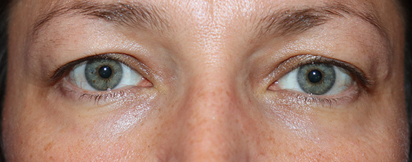 Eyelid Surgery Case 38067 Before Photo Eyelid Surgery