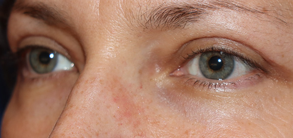 Eyelid Surgery Case 38067 After Photo Eyelid Surgery