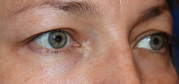 Eyelid Surgery Case 38067 Before Photo Eyelid Surgery