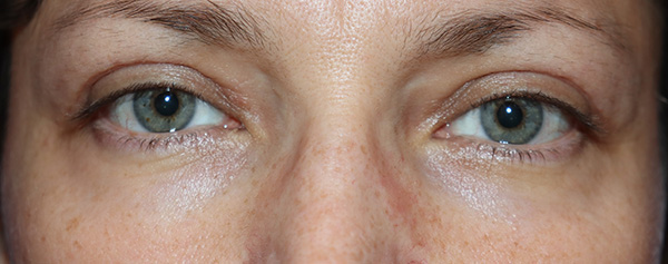 Eyelid Surgery Case 38067 After Photo Eyelid Surgery