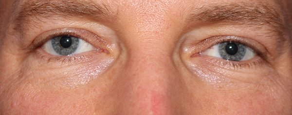 Eyelid Surgery