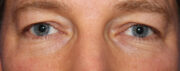 Eyelid Surgery