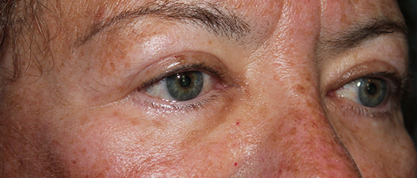 Eyelid Surgery