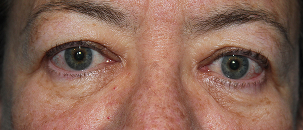 Eyelid Surgery