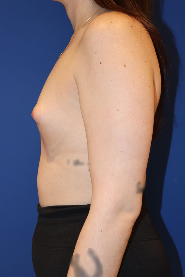 Breast Augmentation Case 38593 Before Photo Breast Augmentation
