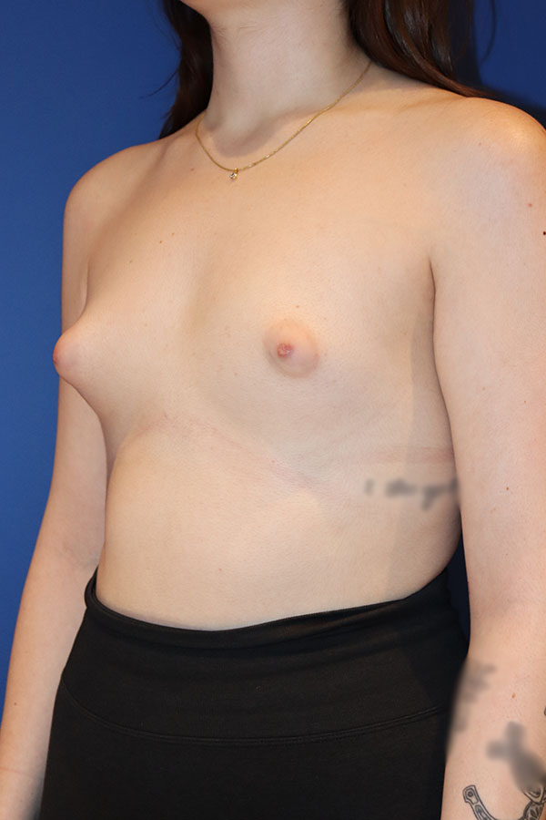 Breast Augmentation Case 38593 Before Photo Breast Augmentation