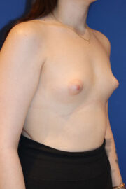 Breast Augmentation