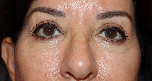 Eyelid Surgery