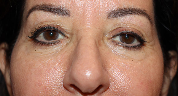 Eyelid Surgery