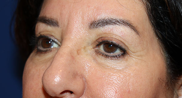 Eyelid Surgery