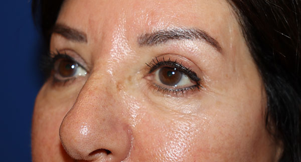 Eyelid Surgery