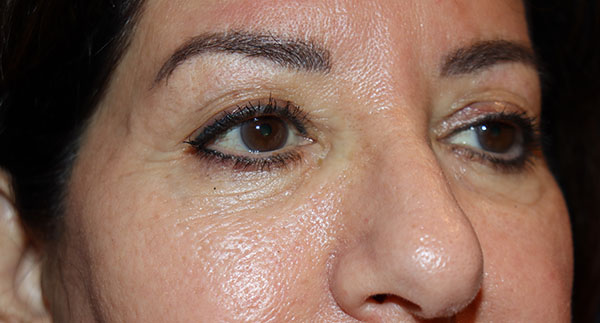 Eyelid Surgery