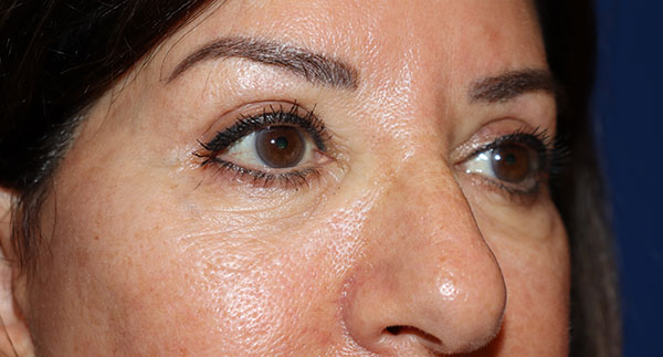 Eyelid Surgery