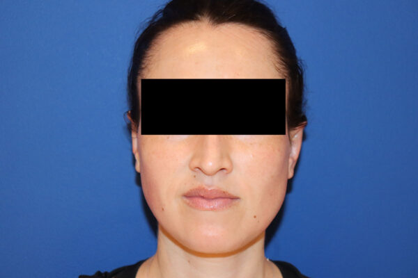 Ear Reshaping - Otoplasty