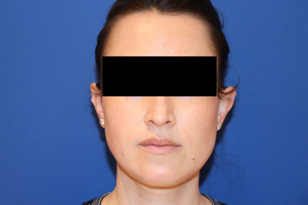 Ear Reshaping - Otoplasty