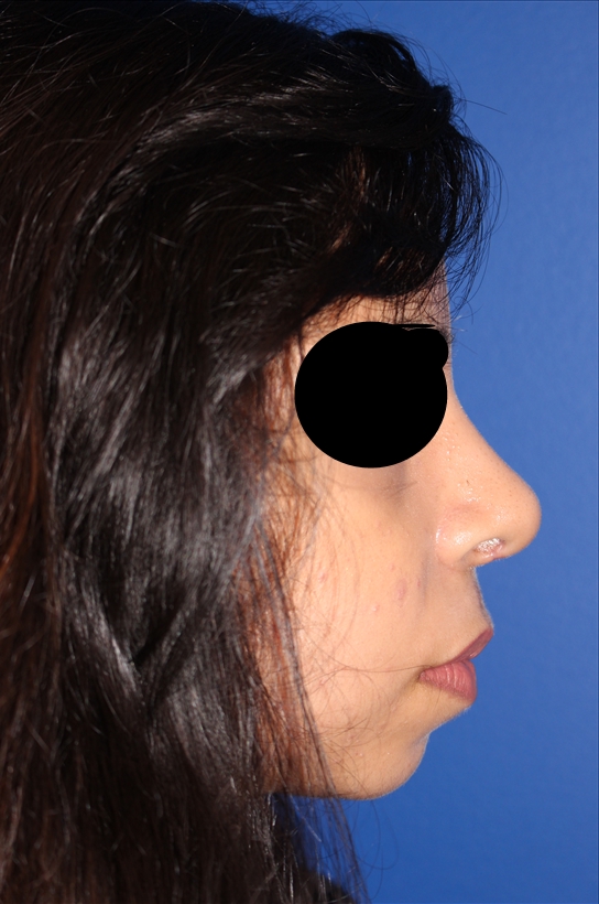 Rhinoplasty - Nasal Reshaping