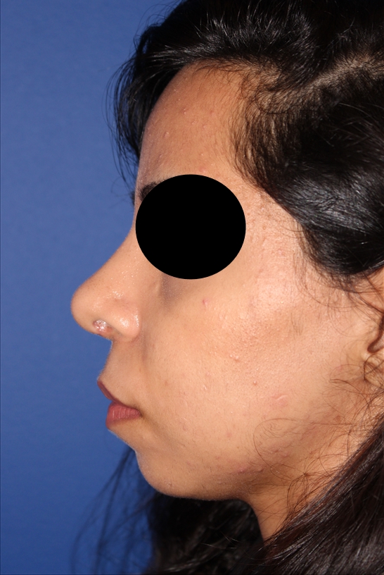 Rhinoplasty - Nasal Reshaping