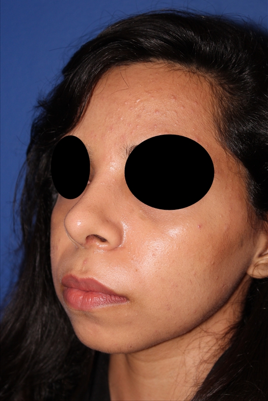 Rhinoplasty - Nasal Reshaping