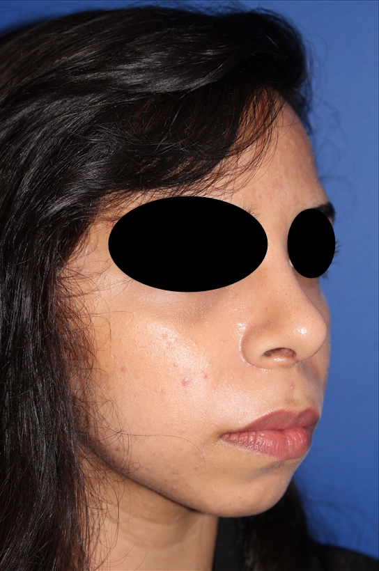 Rhinoplasty - Nasal Reshaping