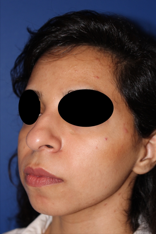 Rhinoplasty - Nasal Reshaping