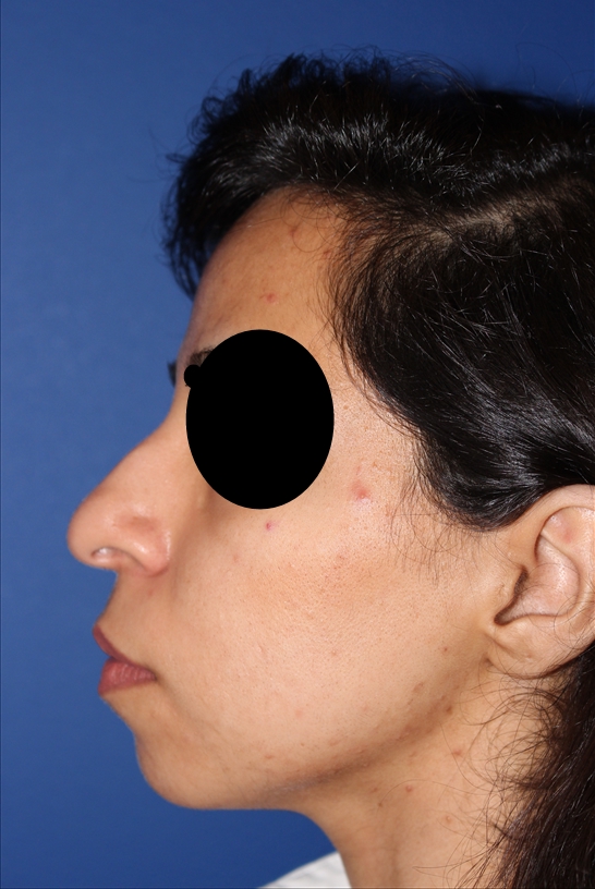 Rhinoplasty - Nasal Reshaping