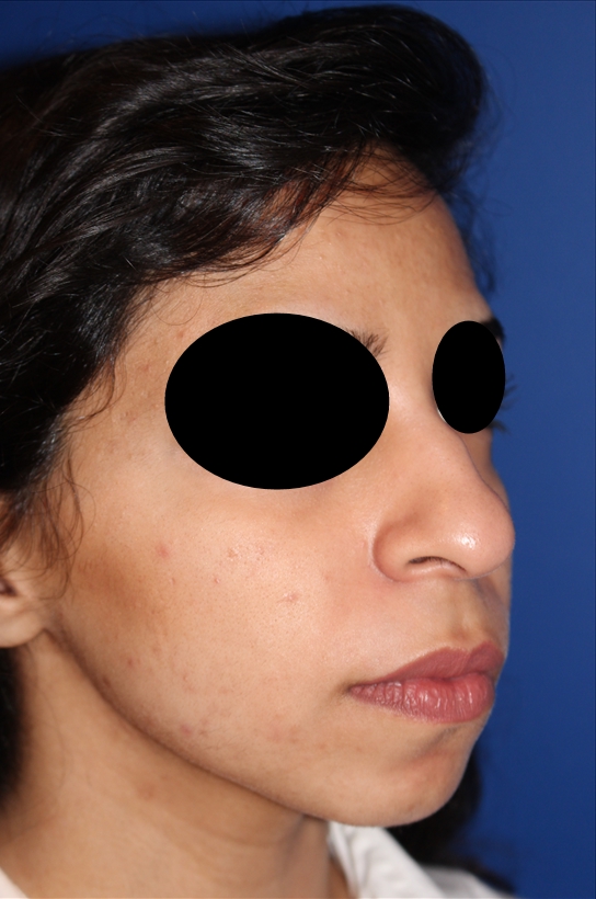 Rhinoplasty - Nasal Reshaping