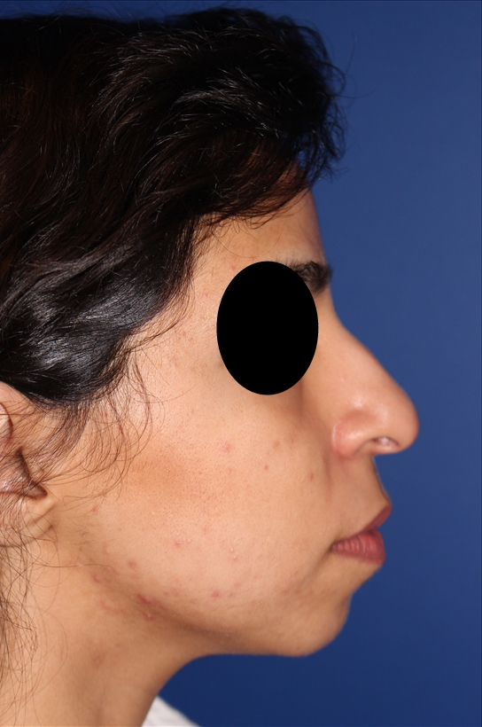 Rhinoplasty - Nasal Reshaping