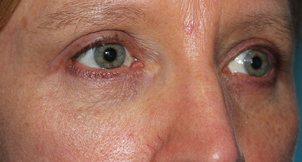 Eyelid Surgery Case 39498 After Photo Eyelid Surgery