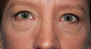 Eyelid Surgery