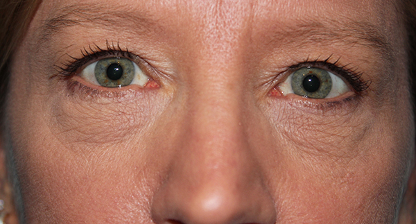 Eyelid Surgery Case 39498 Before Photo Eyelid Surgery