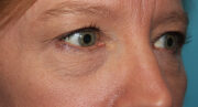 Eyelid Surgery