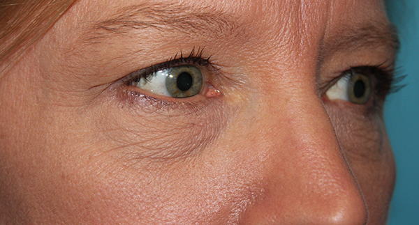 Eyelid Surgery Case 39498 Before Photo Eyelid Surgery