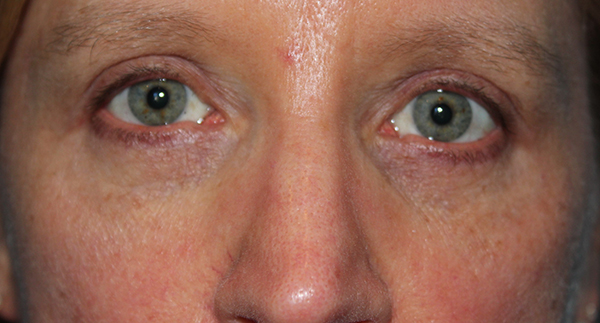 Eyelid Surgery Case 39498 After Photo Eyelid Surgery