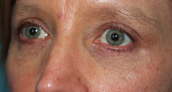 Eyelid Surgery Case 39498 After Photo Eyelid Surgery