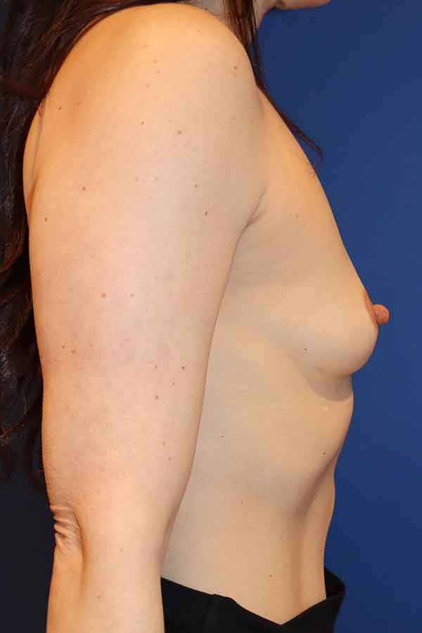 Breast Augmentation Case 40084 Before Photo Breast Augmentation