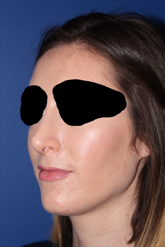 Rhinoplasty - Nasal Reshaping