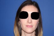 Rhinoplasty - Nasal Reshaping