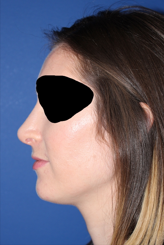 Rhinoplasty - Nasal Reshaping