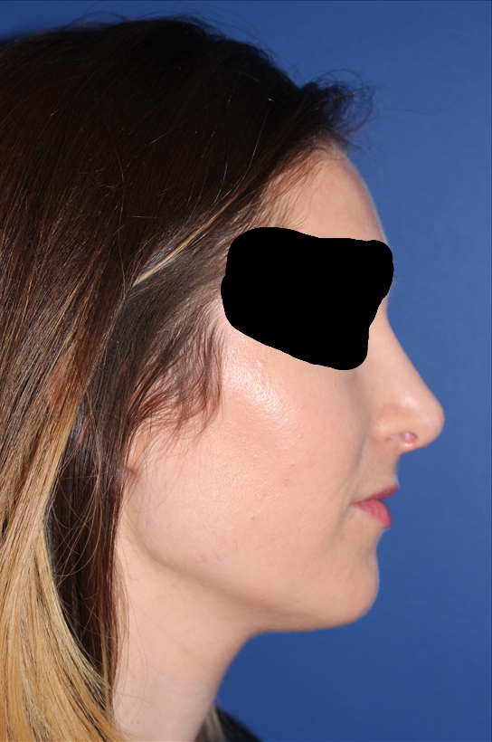 Rhinoplasty - Nasal Reshaping