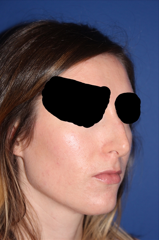 Rhinoplasty - Nasal Reshaping