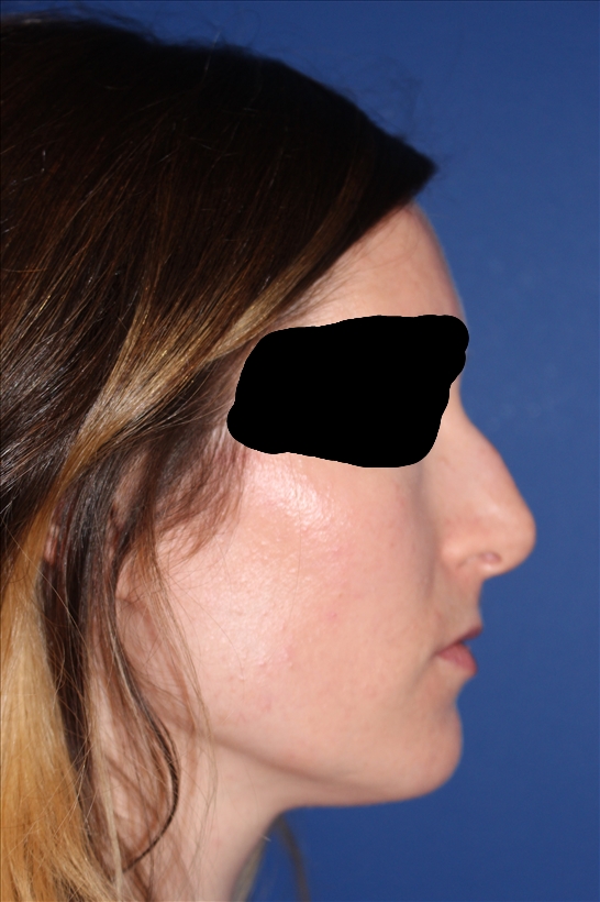 Rhinoplasty - Nasal Reshaping