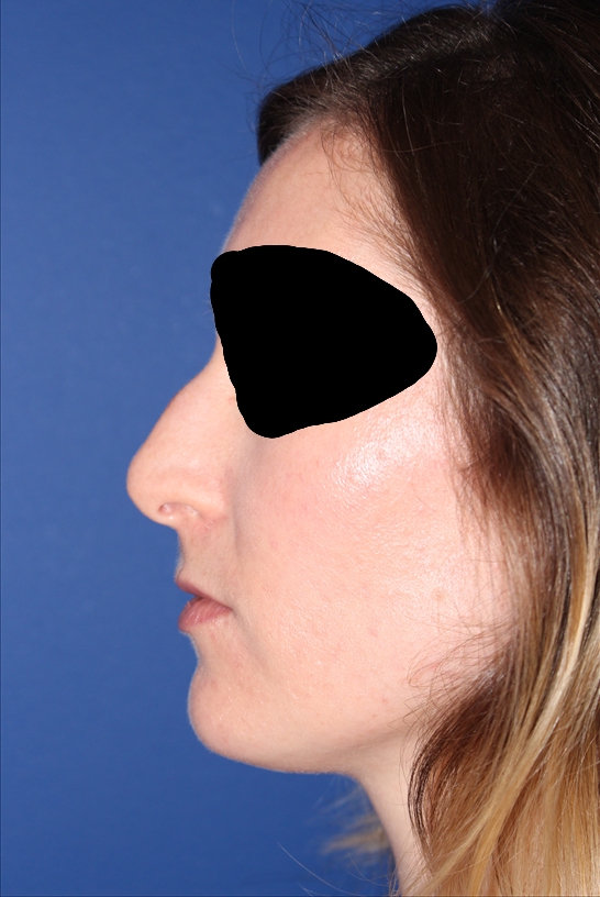 Rhinoplasty - Nasal Reshaping