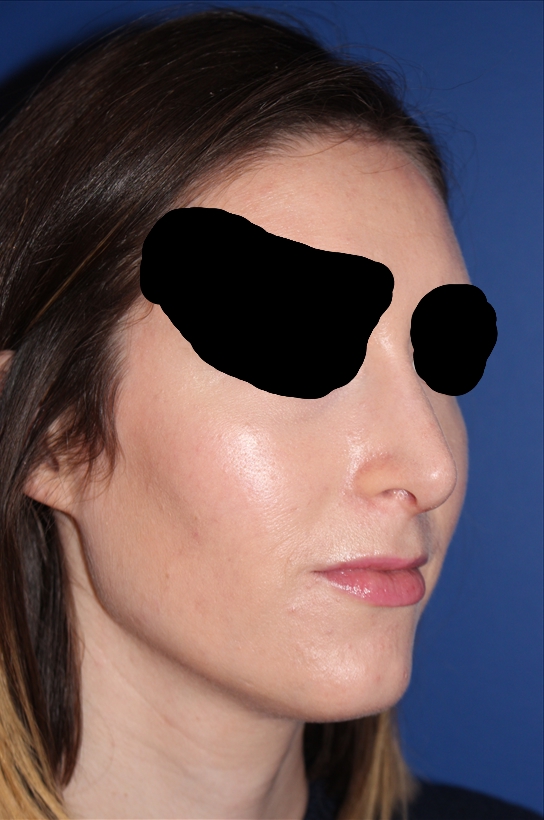 Rhinoplasty - Nasal Reshaping