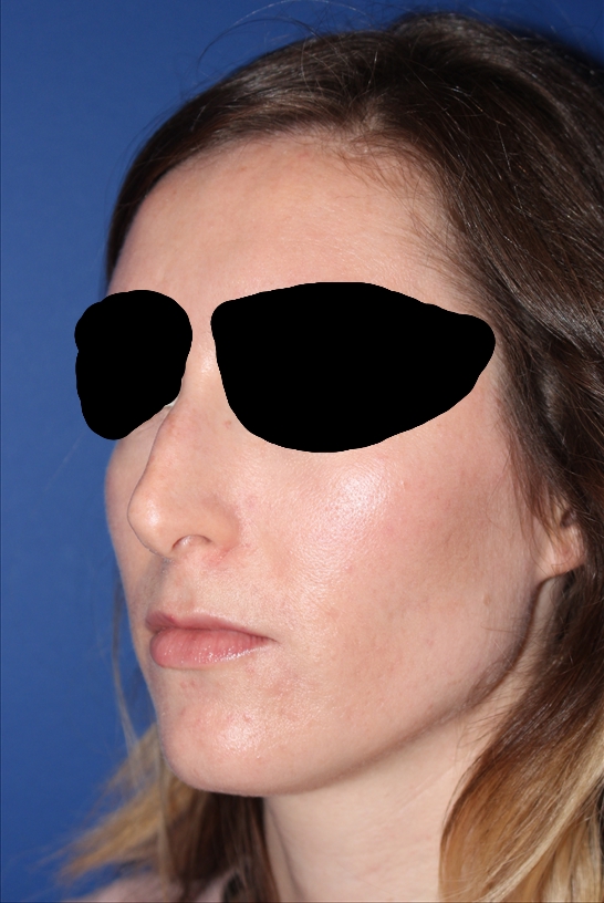 Rhinoplasty - Nasal Reshaping