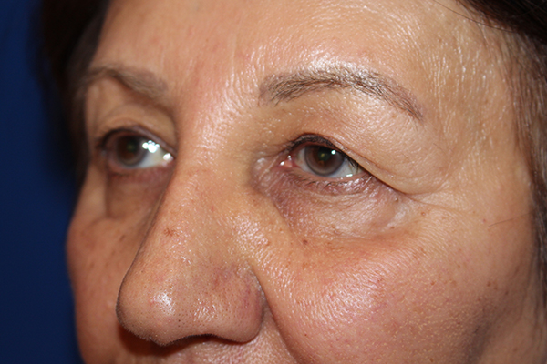 Eyelid Surgery Case 40848 Before Photo Eyelid Surgery